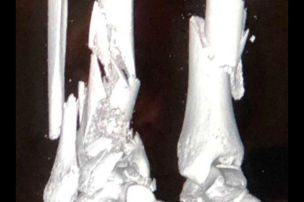 R�ntgenbilder vom zerst�rten Bein
